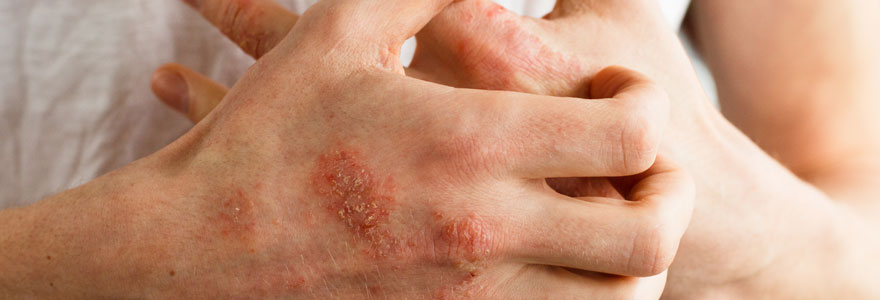 Psoriasis en goutte